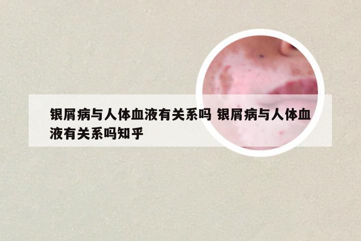银屑病与人体血液有关系吗 银屑病与人体血液有关系吗知乎