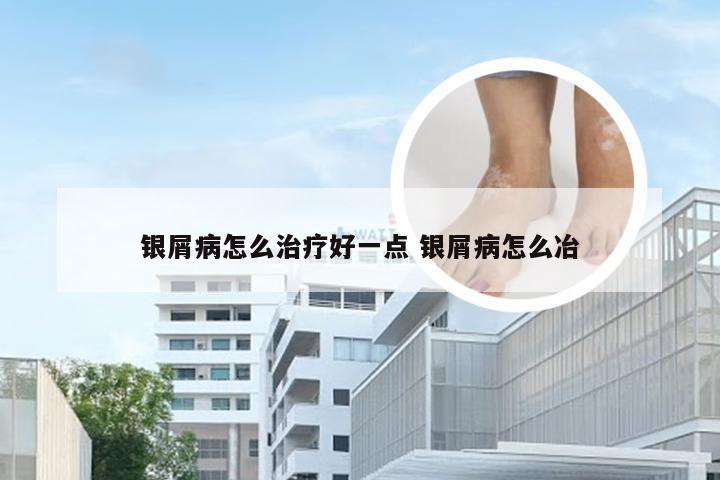 银屑病怎么治疗好一点 银屑病怎么冶