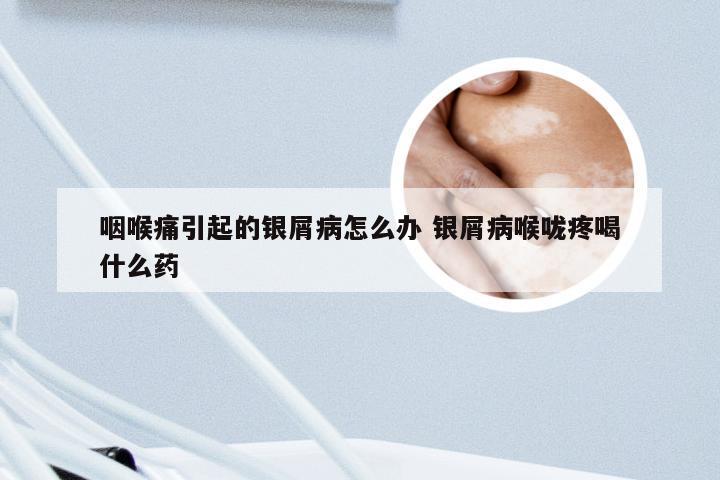 咽喉痛引起的银屑病怎么办 银屑病喉咙疼喝什么药