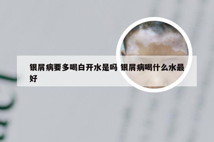 银屑病要多喝白开水是吗 银屑病喝什么水最好
