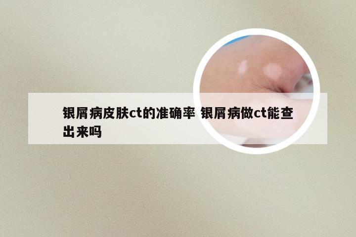 银屑病皮肤ct的准确率 银屑病做ct能查出来吗