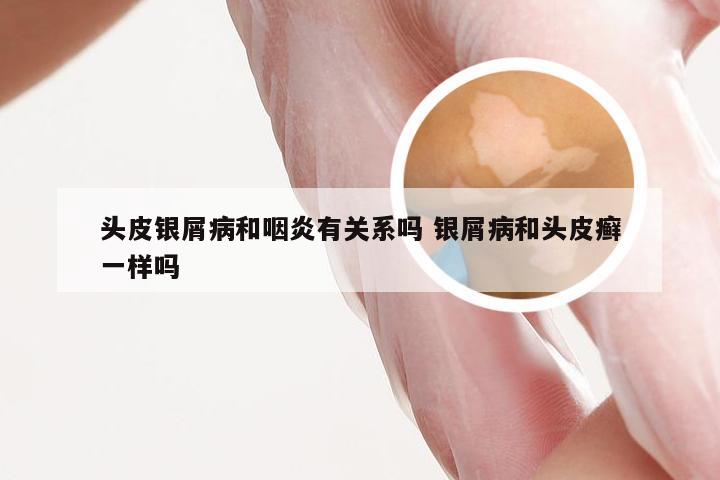 头皮银屑病和咽炎有关系吗 银屑病和头皮癣一样吗