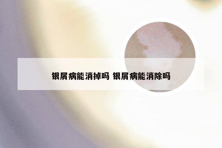 银屑病能消掉吗 银屑病能消除吗