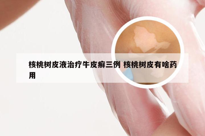 核桃树皮液治疗牛皮癣三例 核桃树皮有啥药用