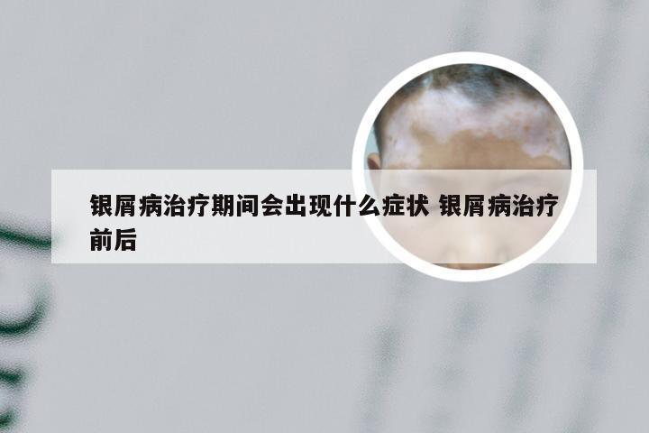 银屑病治疗期间会出现什么症状 银屑病治疗前后