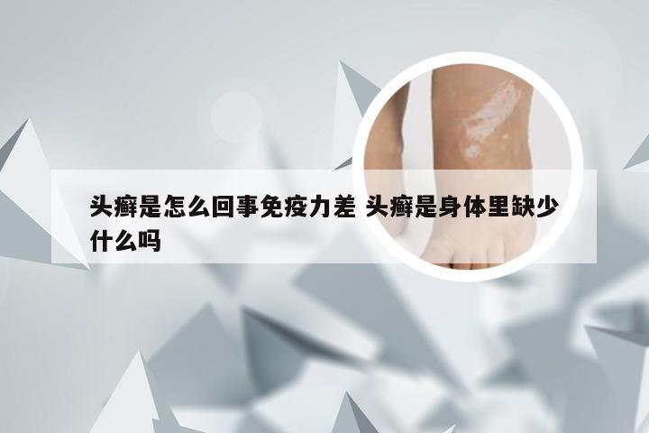 头癣是怎么回事免疫力差 头癣是身体里缺少什么吗
