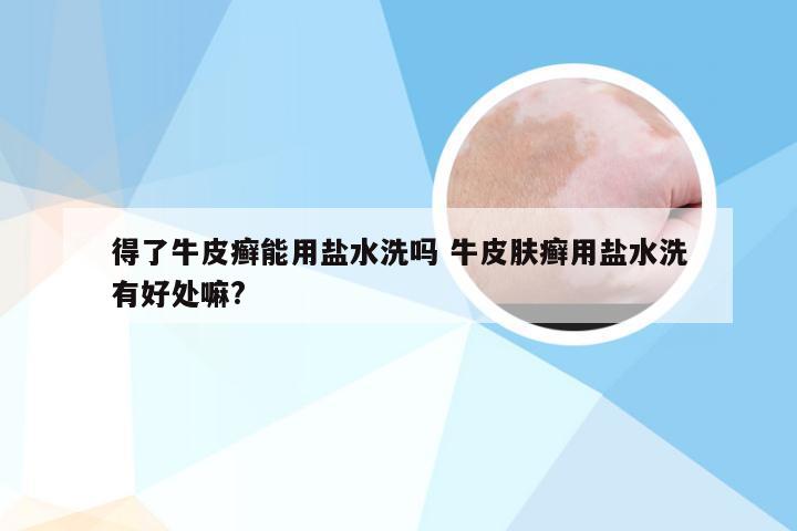得了牛皮癣能用盐水洗吗 牛皮肤癣用盐水洗有好处嘛?