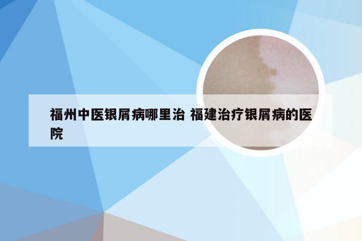 福州中医银屑病哪里治 福建治疗银屑病的医院