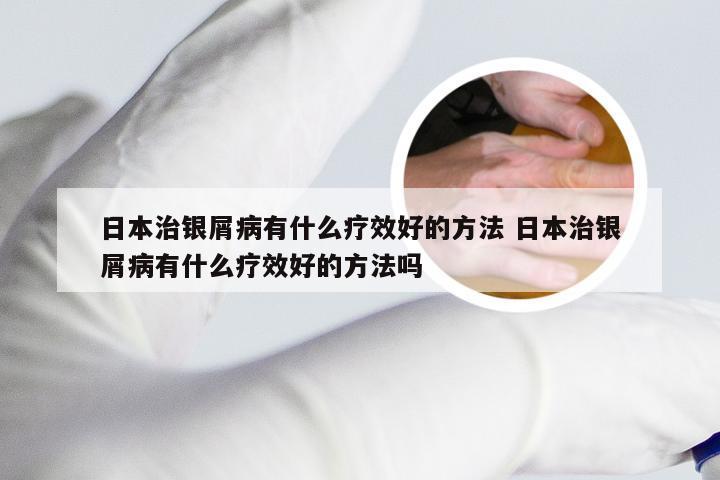 日本治银屑病有什么疗效好的方法 日本治银屑病有什么疗效好的方法吗