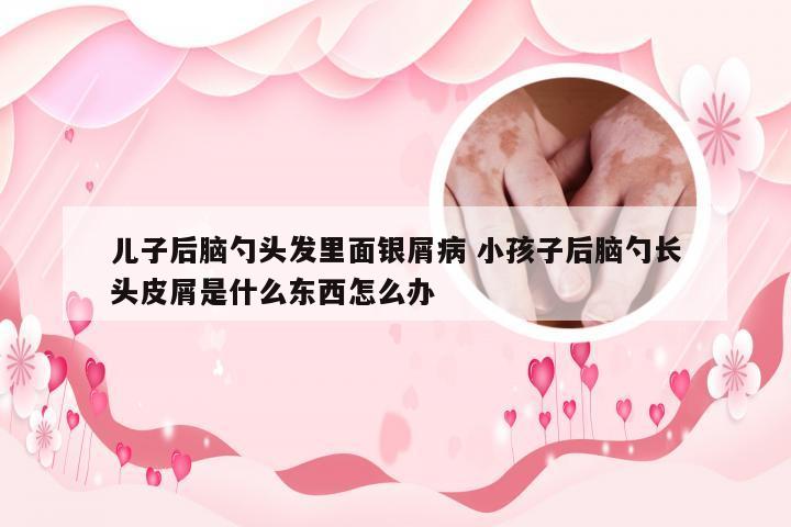 儿子后脑勺头发里面银屑病 小孩子后脑勺长头皮屑是什么东西怎么办
