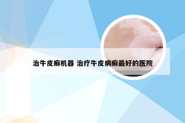 治牛皮癣机器 治疗牛皮病癣最好的医院