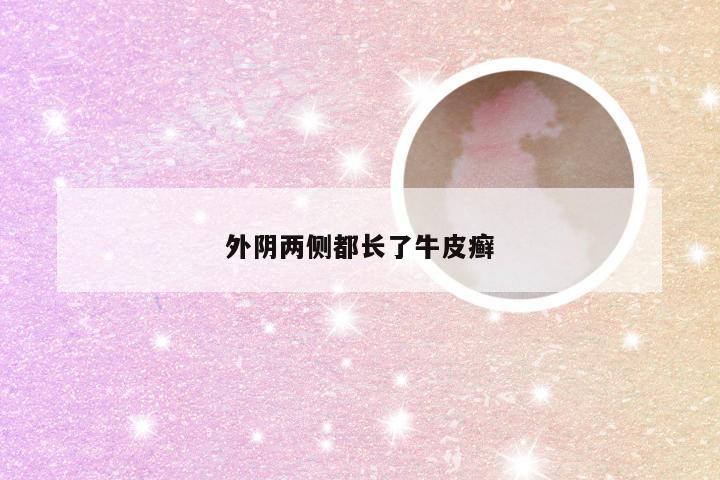 外阴两侧都长了牛皮癣