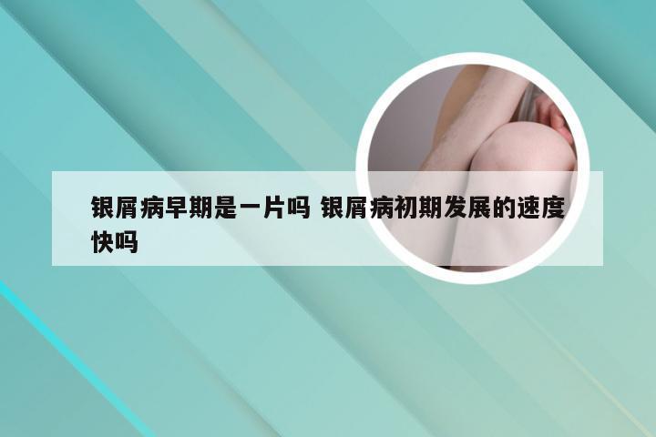 银屑病早期是一片吗 银屑病初期发展的速度快吗