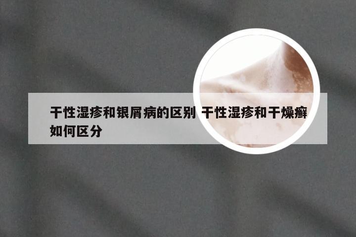 干性湿疹和银屑病的区别 干性湿疹和干燥癣如何区分