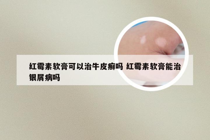 红霉素软膏可以治牛皮癣吗 红霉素软膏能治银屑病吗