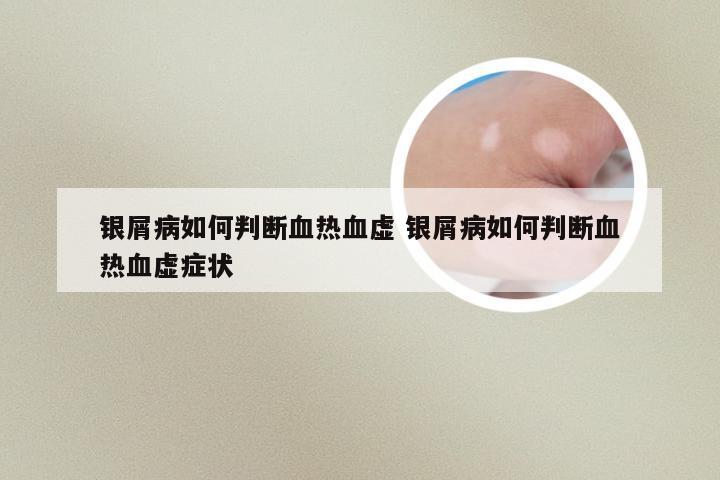 银屑病如何判断血热血虚 银屑病如何判断血热血虚症状