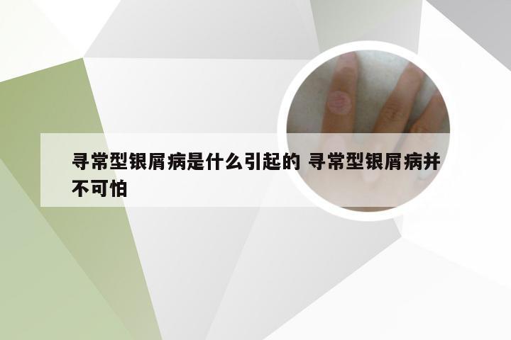 寻常型银屑病是什么引起的 寻常型银屑病并不可怕