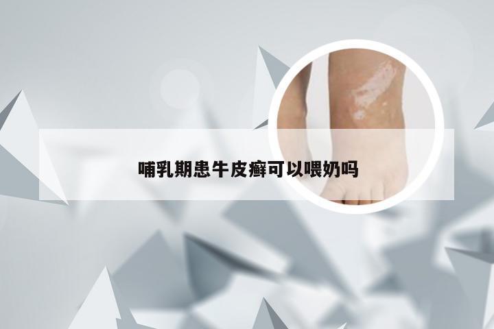 哺乳期患牛皮癣可以喂奶吗