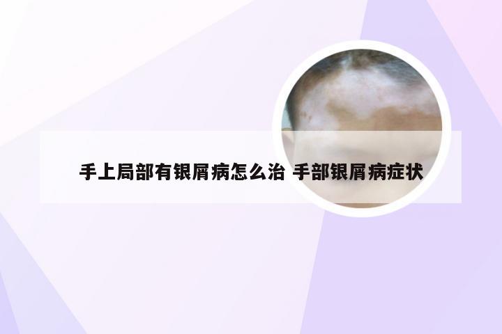 手上局部有银屑病怎么治 手部银屑病症状