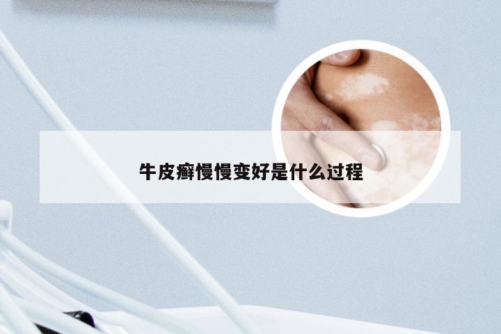 牛皮癣慢慢变好是什么过程