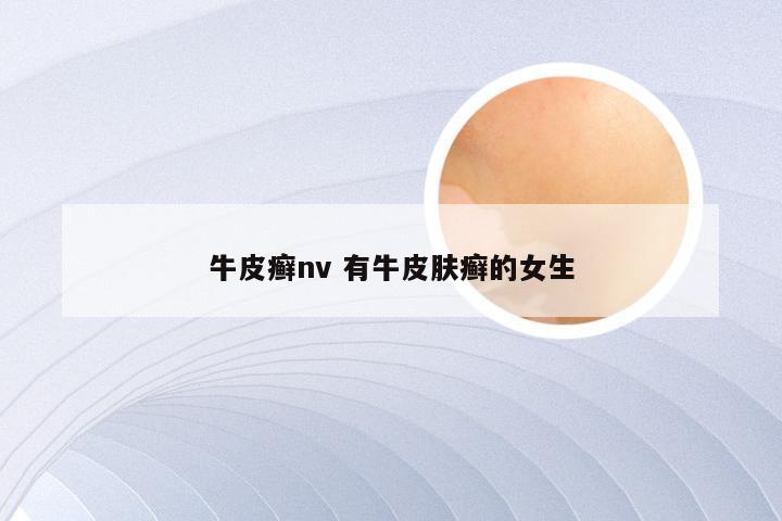 牛皮癣nv 有牛皮肤癣的女生