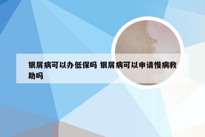 银屑病可以办低保吗 银屑病可以申请慢病救助吗
