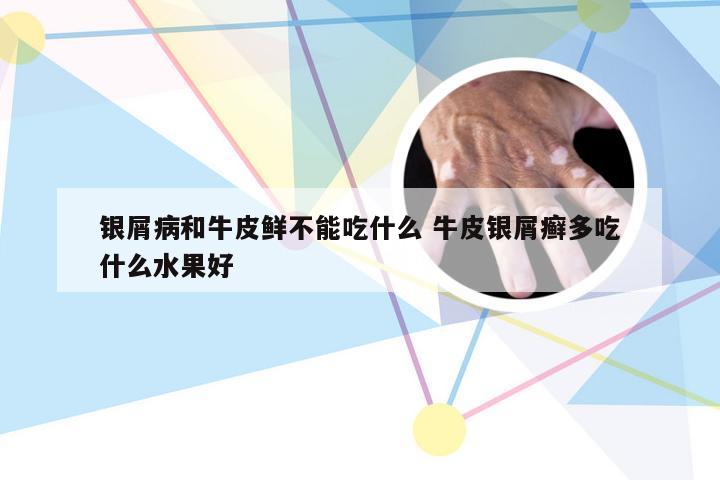 银屑病和牛皮鲜不能吃什么 牛皮银屑癣多吃什么水果好