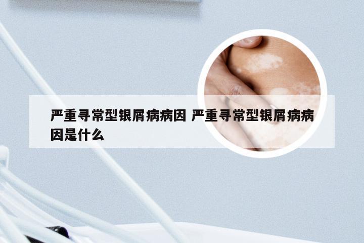 严重寻常型银屑病病因 严重寻常型银屑病病因是什么