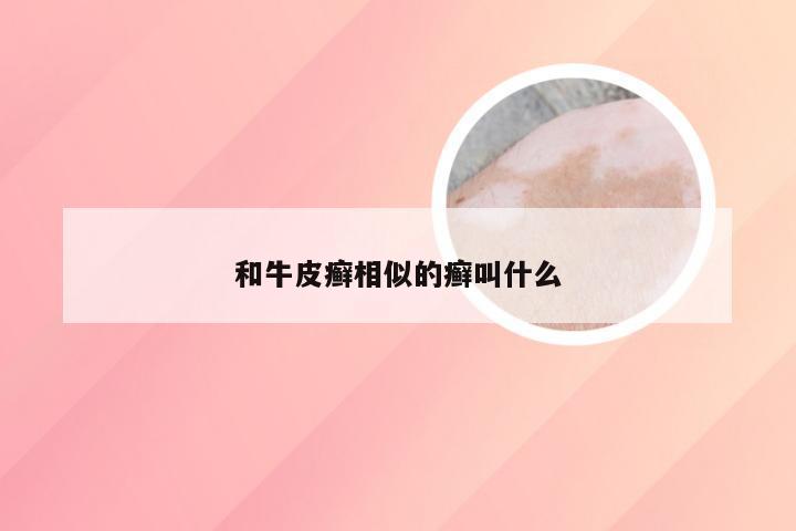 和牛皮癣相似的癣叫什么