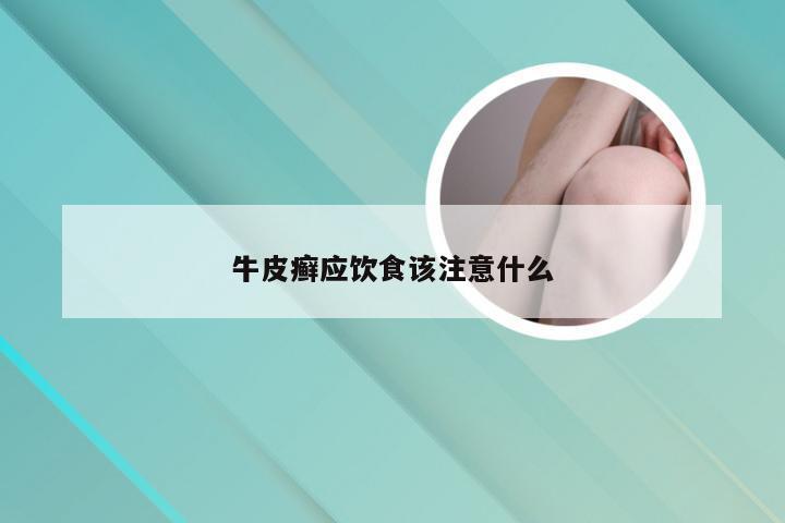 牛皮癣应饮食该注意什么