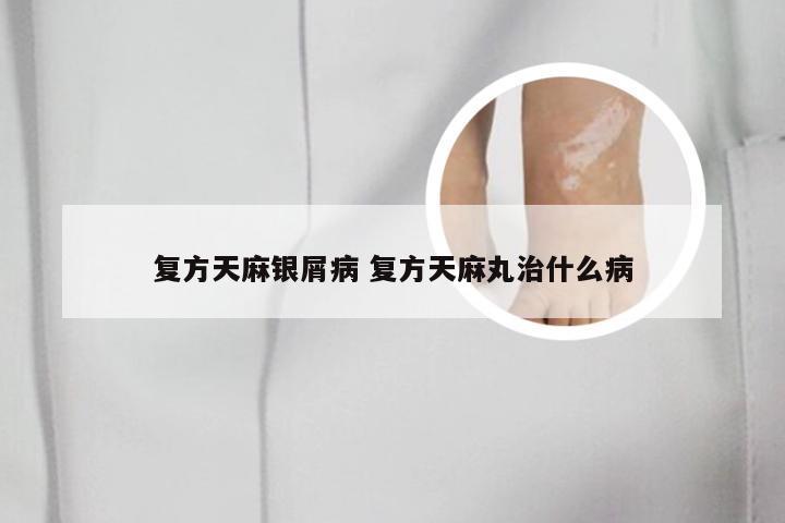 复方天麻银屑病 复方天麻丸治什么病