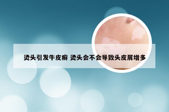 烫头引发牛皮癣 烫头会不会导致头皮屑增多