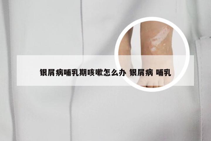 银屑病哺乳期咳嗽怎么办 银屑病 哺乳