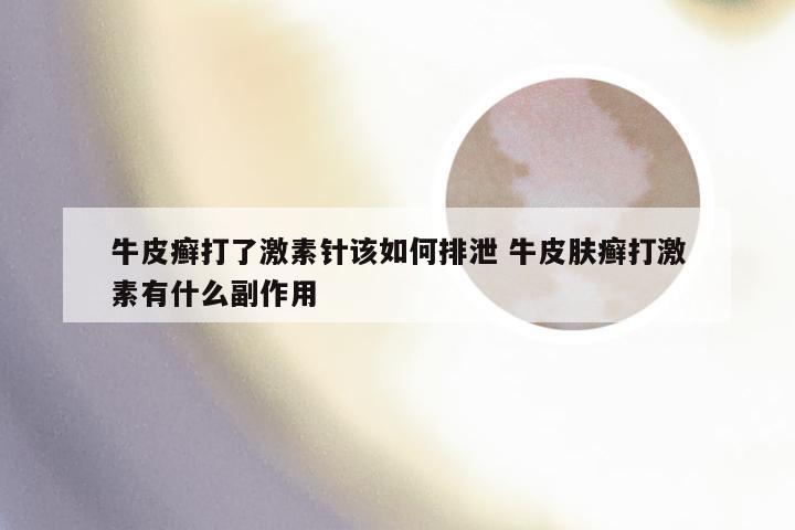 牛皮癣打了激素针该如何排泄 牛皮肤癣打激素有什么副作用