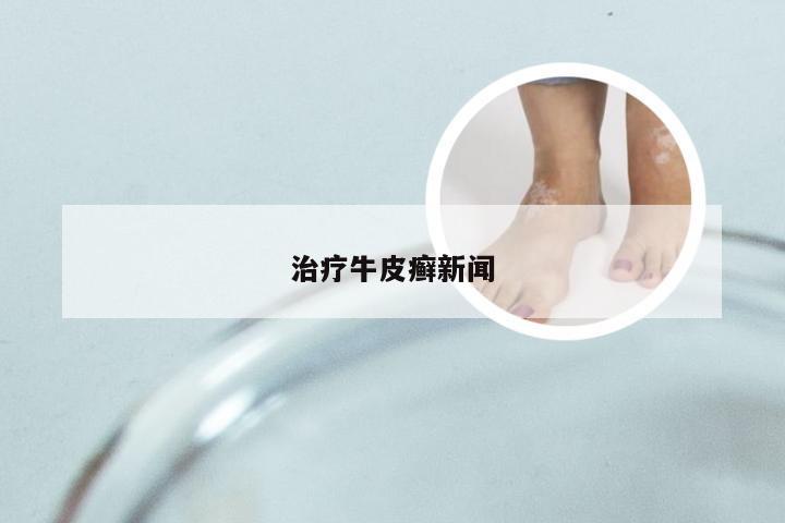 治疗牛皮癣新闻