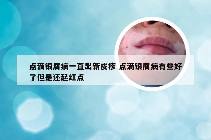 点滴银屑病一直出新皮疹 点滴银屑病有些好了但是还起红点