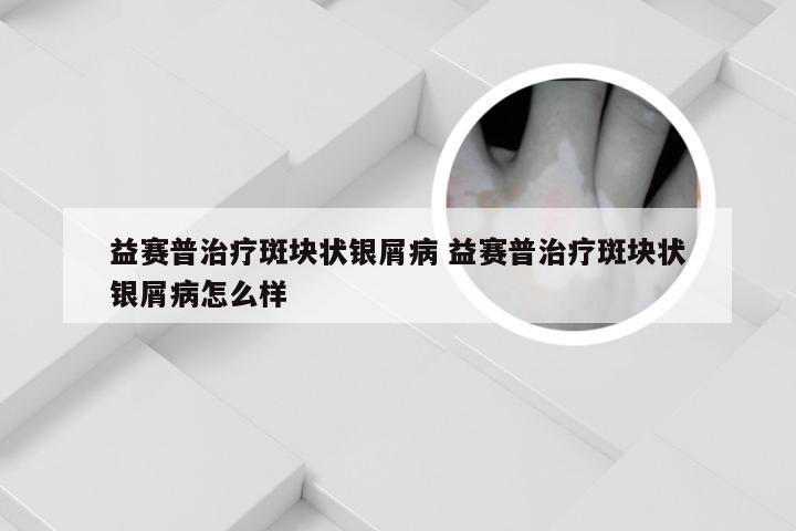 益赛普治疗斑块状银屑病 益赛普治疗斑块状银屑病怎么样