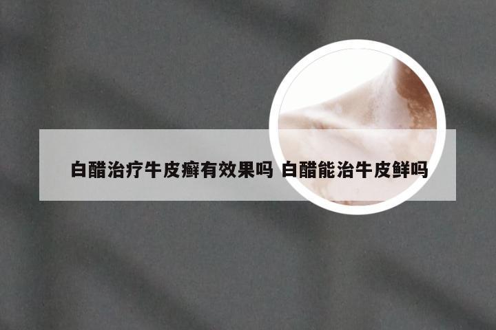 白醋治疗牛皮癣有效果吗 白醋能治牛皮鲜吗