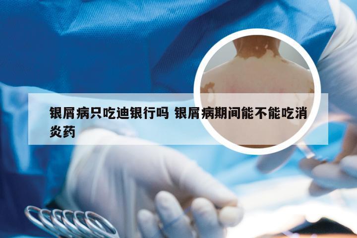 银屑病只吃迪银行吗 银屑病期间能不能吃消炎药