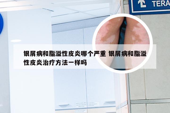 银屑病和脂溢性皮炎哪个严重 银屑病和脂溢性皮炎治疗方法一样吗