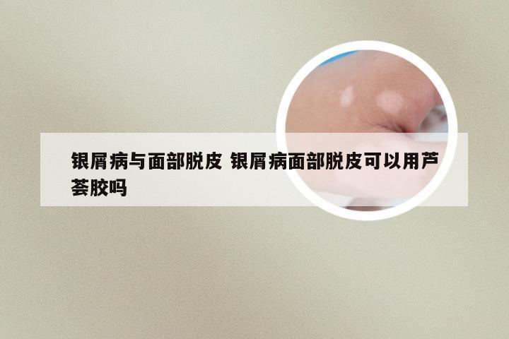 银屑病与面部脱皮 银屑病面部脱皮可以用芦荟胶吗