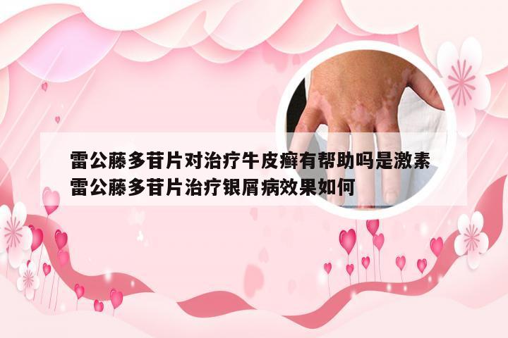 雷公藤多苷片对治疗牛皮癣有帮助吗是激素 雷公藤多苷片治疗银屑病效果如何