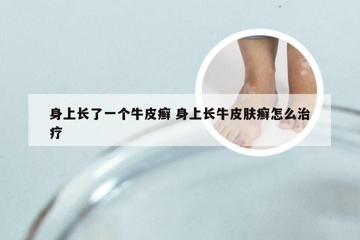身上长了一个牛皮癣 身上长牛皮肤癣怎么治疗