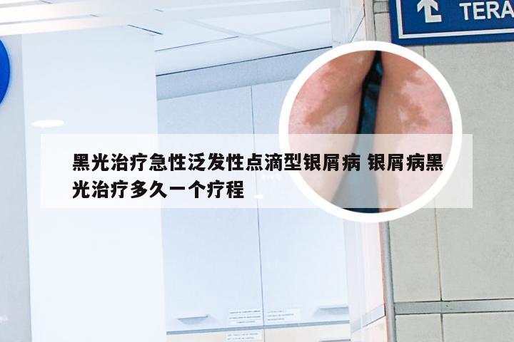 黑光治疗急性泛发性点滴型银屑病 银屑病黑光治疗多久一个疗程