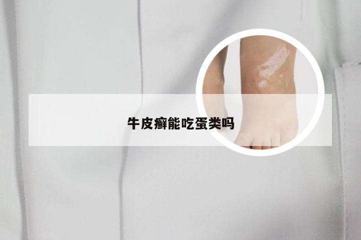 牛皮癣能吃蛋类吗