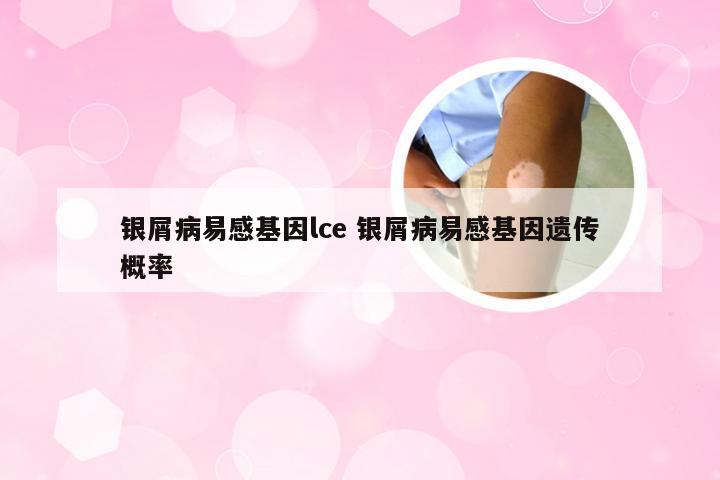 银屑病易感基因lce 银屑病易感基因遗传概率