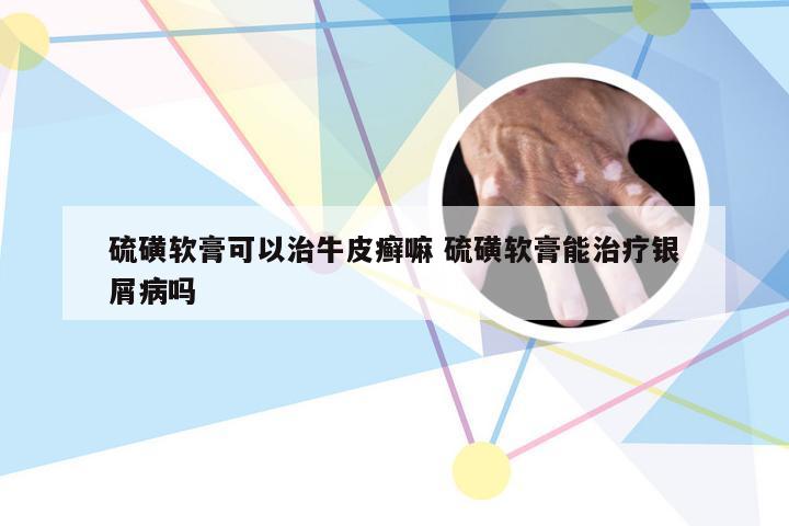 硫磺软膏可以治牛皮癣嘛 硫磺软膏能治疗银屑病吗