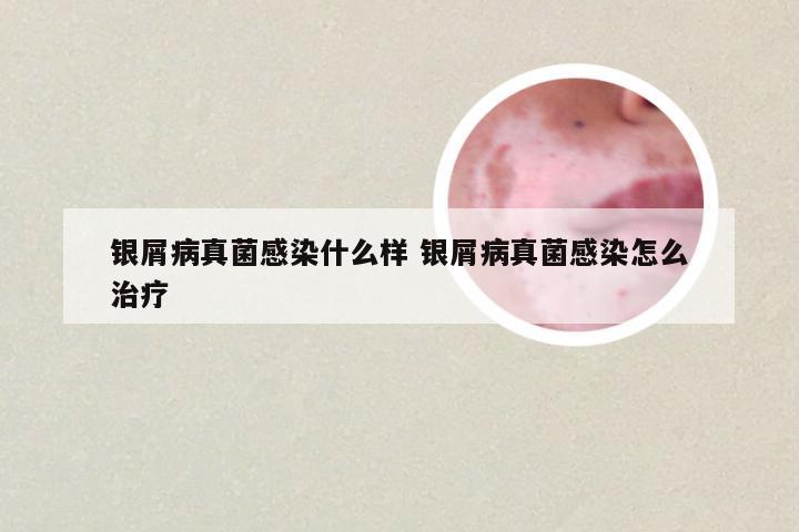 银屑病真菌感染什么样 银屑病真菌感染怎么治疗
