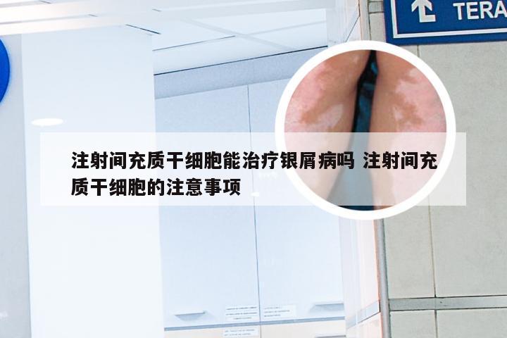 注射间充质干细胞能治疗银屑病吗 注射间充质干细胞的注意事项
