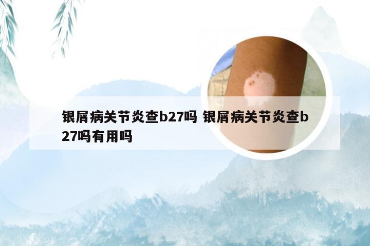 银屑病关节炎查b27吗 银屑病关节炎查b27吗有用吗